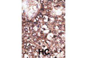 Formalin-fixed and paraffin-embedded human hepatocellular carcinoma tissue reacted with LRP8 polyclonal antibody  , which was peroxidase-conjugated to the secondary antibody, followed by DAB staining. (LRP8 anticorps  (AA 934-963))