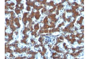 Formalin-fixed, paraffin-embedded human Hepatocellular Carcinoma stained with RBP1 Mouse Monoclonal Antibody (G4E4). (RBP4 anticorps)