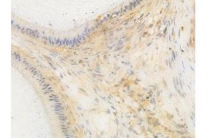 ABIN6259959 and ABIN6266647 at 1/100 staining human testicular cancer by IHC-P.
