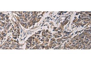 Immunohistochemistry of paraffin-embedded Human colorectal cancer tissue using MAPKAPK3 Polyclonal Antibody at dilution of 1:95(x200)