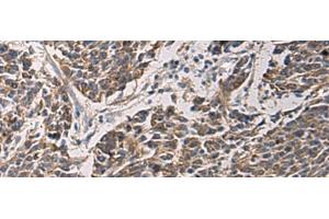 Immunohistochemistry of paraffin-embedded Human colorectal cancer tissue using MAPKAPK3 Polyclonal Antibody at dilution of 1:95(x200) (MAPKAP Kinase 3 anticorps)