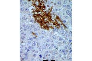 Formalin-fixed and paraffin-embedded human cancer tissue reacted with the primary antibody, which was peroxidase-conjugated to the secondary antibody, followed by AEC staining. (PNCK anticorps  (C-Term))