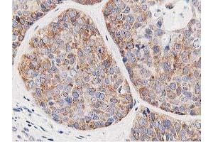 Immunohistochemical staining of paraffin-embedded Adenocarcinoma of Human breast tissue using anti-LCMT1 mouse monoclonal antibody. (LCMT1 anticorps)