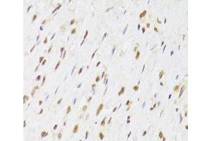 Immunohistochemistry of paraffin-embedded Human gastric cancer using RUVBL1 Polyclonal Antibody at dilution of 1:100 (40x lens). (RUVBL1 anticorps)