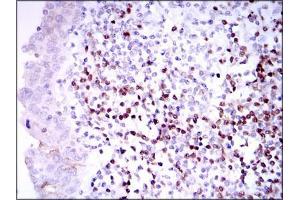 Immunohistochemical analysis of paraffin-embedded endometrial cancer tissues using PAX5 mouse mAb with DAB staining.