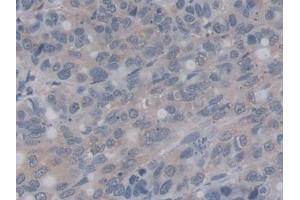 Detection of RALA in Human Stomach cancer Tissue using Monoclonal Antibody to V-Ral Simian Leukemia Viral Oncogene Homolog A (RALA)