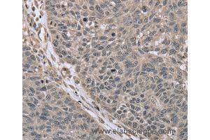 Immunohistochemistry of Human lung cancer using RHEB Polyclonal Antibody at dilution of 1:40 (RHEB anticorps)