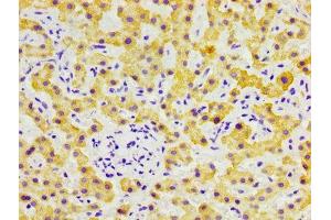IHC image of ABIN7152767 diluted at 1:300 and staining in paraffin-embedded human liver cancer performed on a Leica BondTM system. (FGL1 anticorps  (AA 179-282))