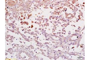 Formalin-fixed and paraffin embedded human endometrial carcinoma labeled with Anti IL-6R alpha/IL-6 receptor ? (IL6RA anticorps  (AA 351-460))