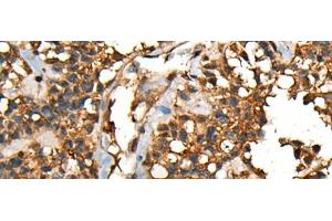 Immunohistochemistry of paraffin-embedded Human ovarian cancer tissue using SHPK Polyclonal Antibody at dilution of 1:45(x200)