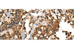 Immunohistochemistry of paraffin-embedded Human ovarian cancer tissue using SHPK Polyclonal Antibody at dilution of 1:45(x200) (SHPK anticorps)