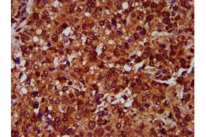IHC image of ABIN7151929 diluted at 1:400 and staining in paraffin-embedded human glioma performed on a Leica BondTM system. (EMP2 anticorps  (AA 22-66))