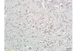 Formalin-fixed and paraffin embedded human hepatoma labeled with Anti-LAMP-3/DC-LAMP/CD208 Polyclonal Antibody, Unconjugated (ABIN742005) at 1:300 followed by conjugation to the secondary antibody and DAB (LAMP3 anticorps  (AA 301-416))