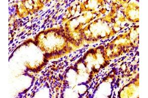 Immunohistochemistry of paraffin-embedded human gastric cancer using ABIN7156813 at dilution of 1:100 (IL17D anticorps  (AA 16-202))