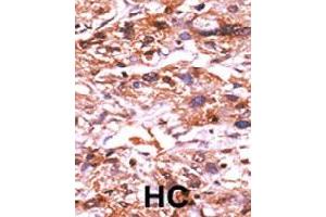 Formalin-fixed and paraffin-embedded human hepatocellular carcinoma tissue reacted with CDC25A (phospho S124) polyclonal antibody  which was peroxidase-conjugated to the secondary antibody followed by AEC staining. (CDC25A anticorps  (pSer124))