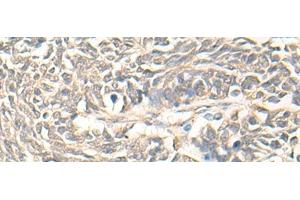 Immunohistochemistry of paraffin-embedded Human lung cancer tissue using DMC1 Polyclonal Antibody at dilution of 1:30(x200) (DMC1 anticorps)