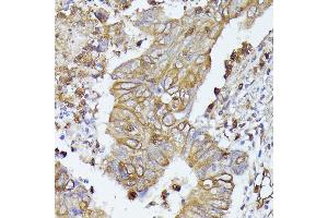 Immunohistochemistry of paraffin-embedded human colon carcinoma using CD52 antibody (ABIN7266207) at dilution of 1:100 (40x lens).