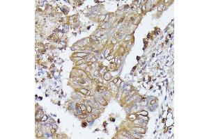 Immunohistochemistry of paraffin-embedded human colon carcinoma using CD52 antibody (ABIN7266207) at dilution of 1:100 (40x lens). (CD52 anticorps  (AA 1-61))