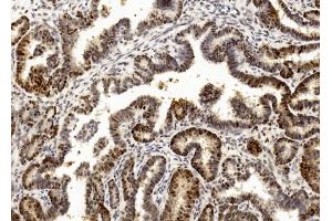 Immunohistochemical analysis of paraffin-embedded Human Ovarian cancer section using Pink1 (ABIN1882273 and ABIN2838445). (PCNA anticorps  (C-Term))