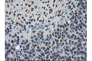 Immunohistochemical staining of paraffin-embedded Adenocarcinoma of colon tissue using anti-MKI67mouse monoclonal antibody.