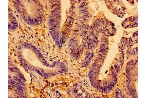 Immunohistochemistry of paraffin-embedded human colon cancer using ABIN7144021 at dilution of 1:100 (AMPD2 anticorps  (AA 1-129))
