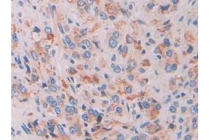 Detection of IFI16 in Human Prostatic adenoma Tissue using Polyclonal Antibody to Interferon Gamma Inducible Protein 16 (IFI16)