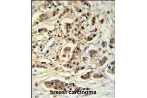 M11D1 Antibody (N-term) (ABIN653932 and ABIN2843164) IHC analysis in formalin fixed and paraffin embedded breast carcinoma followed by peroxidase conjugation of the secondary antibody and DAB staining. (METTL17 anticorps  (N-Term))