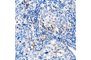 Immunohistochemistry of paraffin-embedded human cervix cancer using IL22 Rabbit pAb (ABIN6128134, ABIN6142363, ABIN6142364 and ABIN6221808) at dilution of 1:1000 (40x lens). (IL-22 anticorps  (AA 34-179))