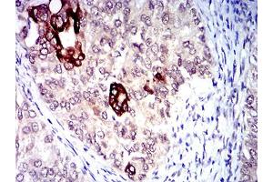 Immunohistochemical analysis of paraffin-embedded cervical cancer tissues using CD183 mouse mAb with DAB staining. (CXCR3 anticorps)