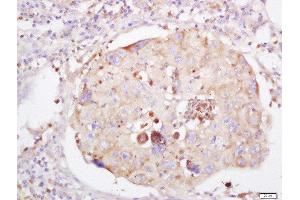 Formalin-fixed and paraffin embedded human lung carcinoma labeled with Anti-LRRC25 Polyclonal Antibody, Unconjugated  at 1:200 followed by conjugation to the secondary antibody and DAB staining (LRRC25 anticorps  (AA 81-180))