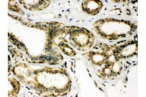 IHC(P): Human Mammary Cancer Tissue