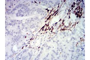 Immunohistochemical analysis of paraffin-embedded rectum cancer tissues using CD45 mouse mAb with DAB staining.