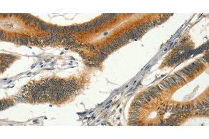 Immunohistochemistry of paraffin-embedded Human colon cancer tissue using CIB1 Polyclonal Antibody at dilution 1:30 (CIB1 anticorps)