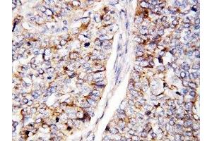 IHC-P: Cdc25B antibody testing of human lung cancer tissue