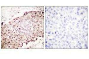 Immunohistochemistry analysis of paraffin-embedded human breast carcinoma tissue using Sumo1 antibody. (SUMO1 anticorps  (N-Term))