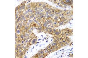 Immunohistochemistry of paraffin-embedded human lung cancer using CLDN1 antibody. (Claudin 1 anticorps)