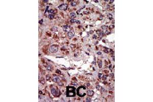 Formalin-fixed and paraffin-embedded human cancer tissue reacted with DGKA polyclonal antibody  , which was peroxidase-conjugated to the secondary antibody, followed by AEC staining. (DGKA anticorps  (C-Term))