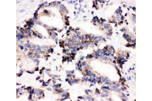 IHC-P: IRAK2 antibody testing of human lung cancer tissue (IRAK2 anticorps  (C-Term))