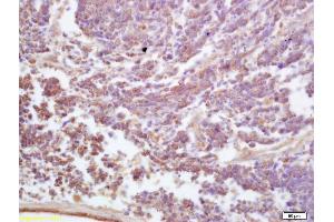 Formalin-fixed and paraffin embedded human lung carcinoma labeled with Anti-ADAM19 Polyclonal Antibody, Unconjugated (ABIN758801) at 1:200 followed by conjugation to the secondary antibody and DAB staining (ADAM19 anticorps  (AA 251-350))