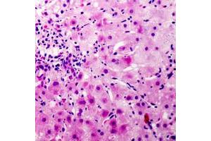 Immunohistochemical analysis of CEP110 staining in human liver cancer formalin fixed paraffin embedded tissue section.
