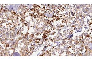 ABIN6276882 at 1/100 staining Human Melanoma tissue by IHC-P. (TFF1 anticorps  (Internal Region))