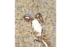 Annexin V Antibody (C-term) (ABIN390502 and ABIN2840858) IHC analysis in formalin fixed and paraffin embedded human hepatocarcinoma followed by peroxidase conjugation of the secondary antibody and DAB staining.