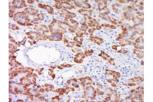 Paraformaldehyde-fixed, paraffin embedded human liver cancer, Antigen retrieval by boiling in sodium citrate buffer (pH6) for 15min, Block endogenous peroxidase by 3% hydrogen peroxide for 30 minutes, Blocking buffer (normal goat serum) at 37°C for 20min, Antibody incubation with SOD1 Polyclonal antibody, Unconjugated  at 1:500 overnight at 4°C, followed by a conjugated secondary and DAB staining (SOD1 anticorps  (AA 6-100))