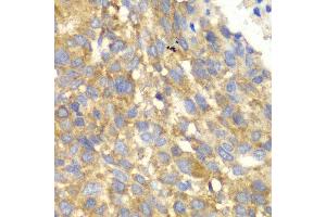 Immunohistochemistry of paraffin-embedded human esophageal cancer using EIF2AK4 antibody at dilution of 1:100 (x40 lens).