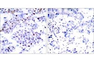 Immunohistochemistry analysis of paraffin-embedded human breast carcinoma tissue, using STAT6 (Ab-645) Antibody. (STAT6 anticorps  (AA 612-661))