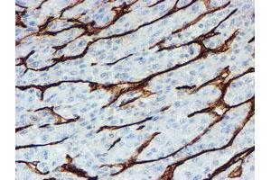 Immunohistochemical staining of paraffin-embedded Carcinoma of Human liver tissue using anti-PECAM1 mouse monoclonal antibody. (CD31 anticorps)