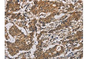 The image is immunohistochemistry of paraffin-embedded Human gastric cancer tissue using ABIN7128636(BCL2L12 Antibody) at dilution 1/20. (BCL2L12 anticorps)