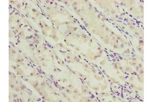 Immunohistochemistry of paraffin-embedded human gastric cancer using ABIN7170275 at dilution of 1:100 (GPR172A anticorps  (AA 217-276))