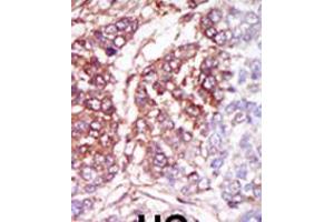 Formalin-fixed and paraffin-embedded human cancer tissue reacted with the primary antibody, which was peroxidase-conjugated to the secondary antibody, followed by DAB staining. (CSNK1G3 anticorps  (C-Term))