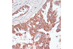 Immunohistochemistry of paraffin-embedded human lung cancer using TI antibody (ABIN6130725, ABIN6149146, ABIN6149147 and ABIN6214431) at dilution of 1:100 (40x lens). (TIAM1 anticorps  (AA 1392-1591))